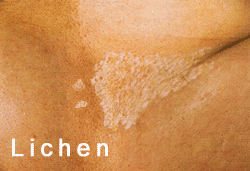 lichen scléroatrophique vulvaire